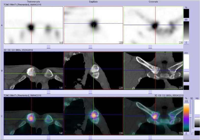 Ost&eacute;ite aseptique de l'extr&ecirc;mit&eacute; interne de la clavicule droite